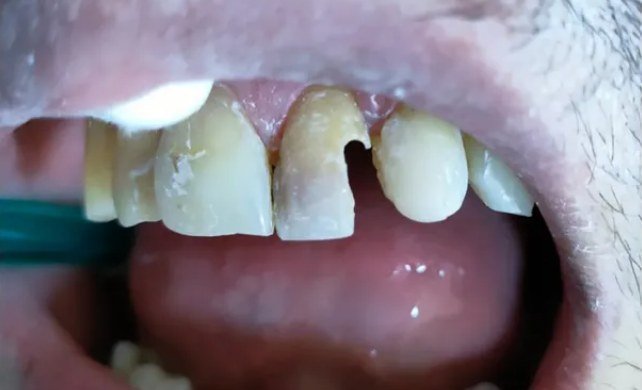 Resultado antes - Restauración dental