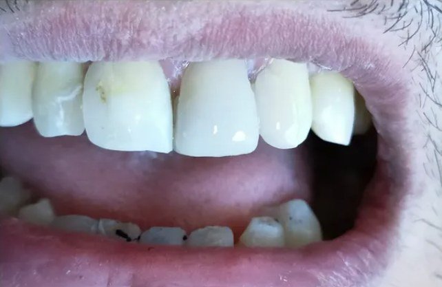 Resultado después - Restauración dental